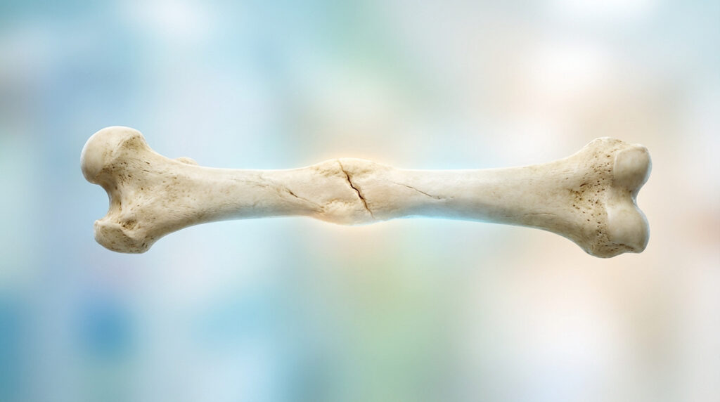 Vue latérale d'un os fracturé en cours de guérison, montrant le cal osseux et la consolidation autour de la cassure, sur fond flou.